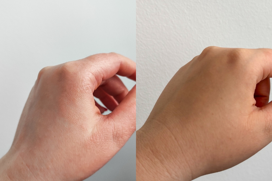 lijecenje_dermatitisa_i_ekcema_zeolit